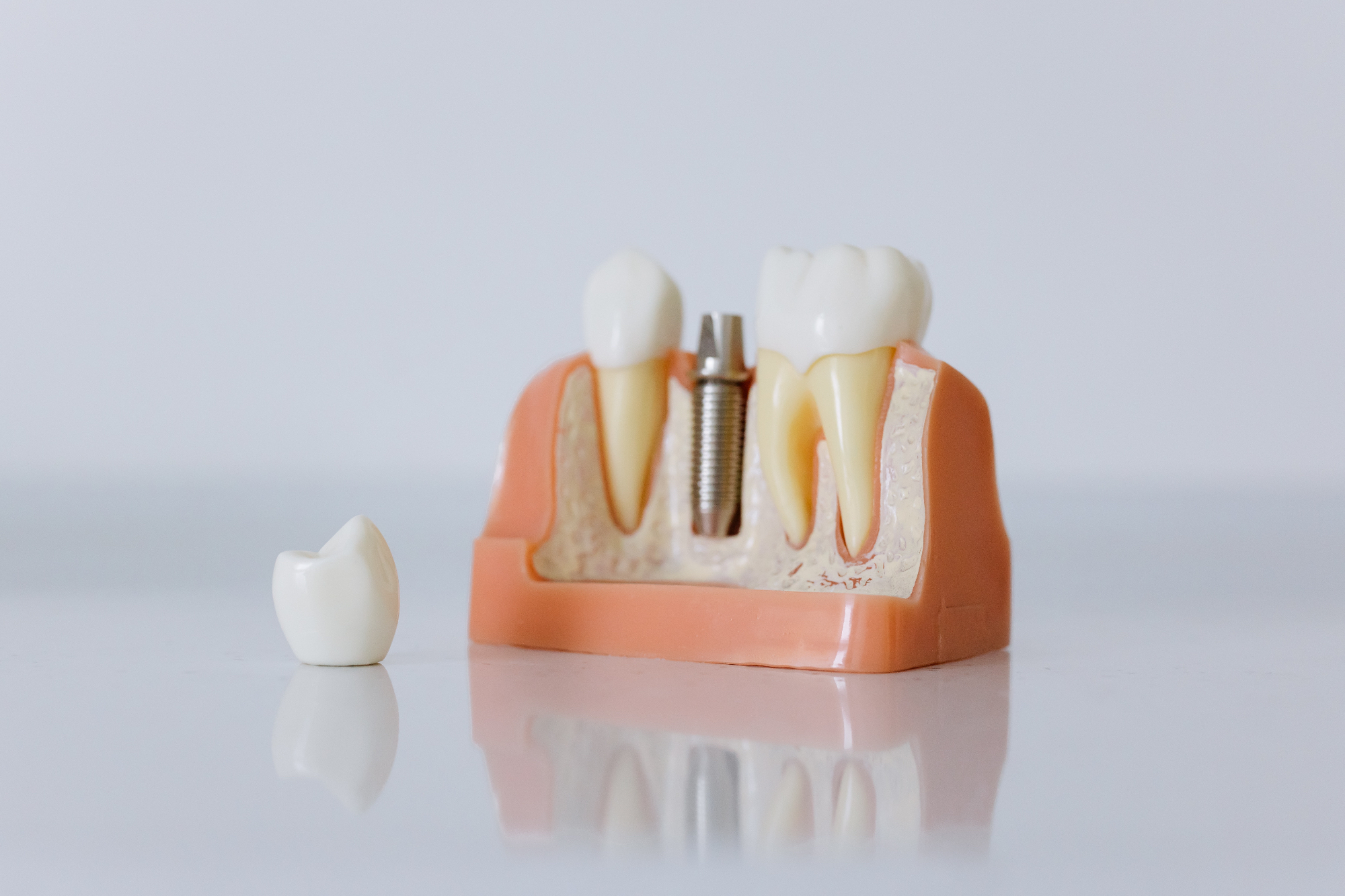 Zobni implantati kot trajna in daleč najboljša rešitev za manjkajoče zobe