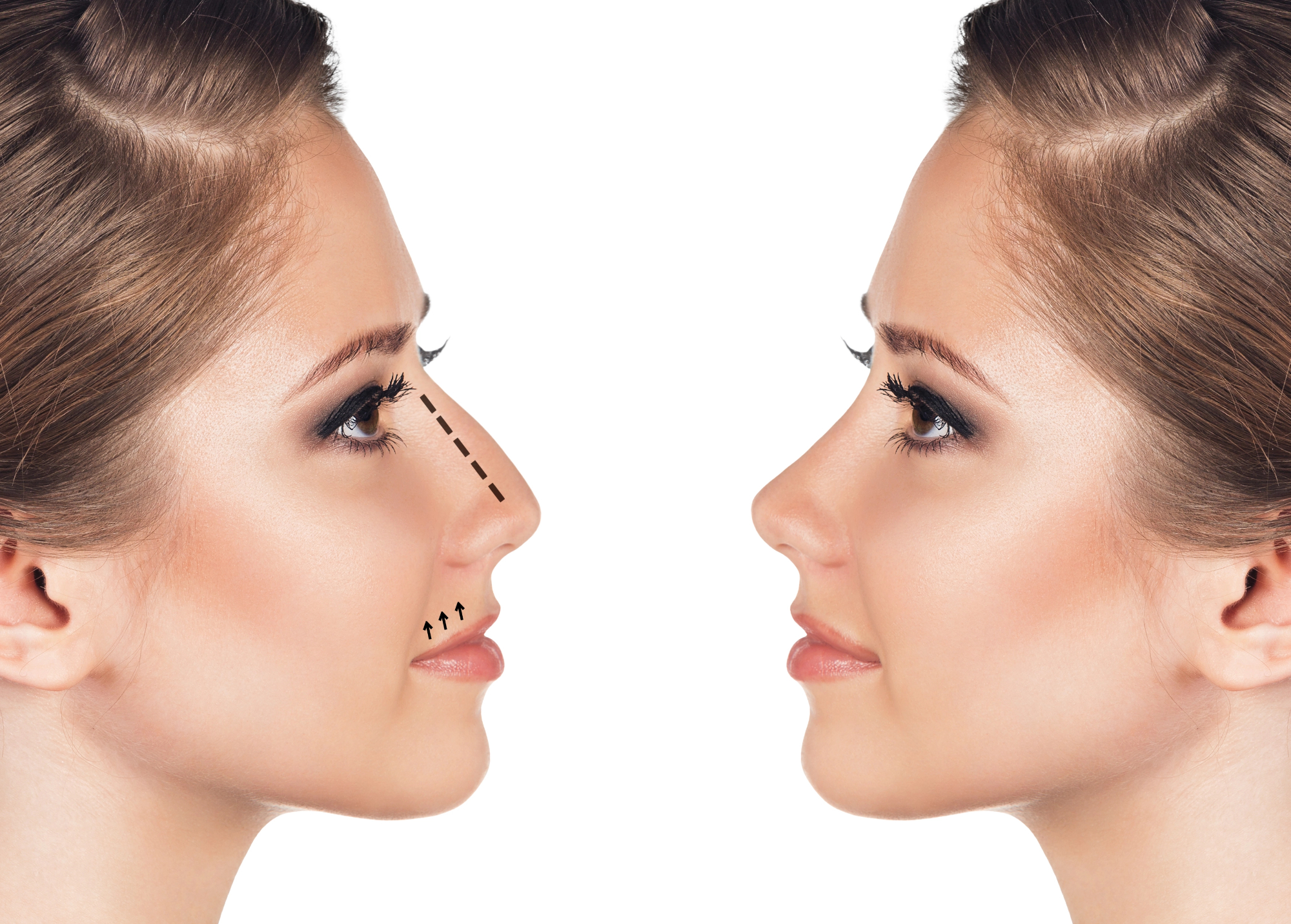 Korekcija nosu naredi veliko razliko v tem, kako se počutiš v svoji koži.